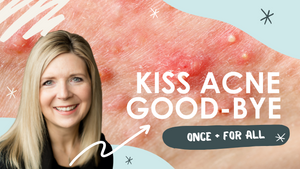 Kiss Your Acne Good-Bye Once + For All