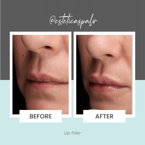Lip Filler in Longview Washington 