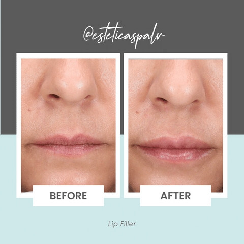Most Natural Lip Filler Injectors in Longview Washington